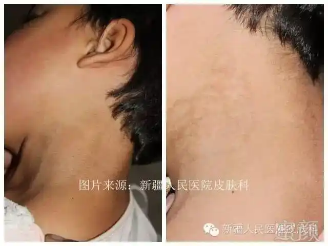 咖啡斑是什么咖啡斑可以治疗吗