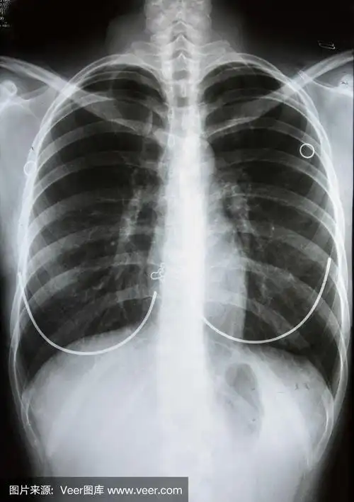 人体胸部x光图像