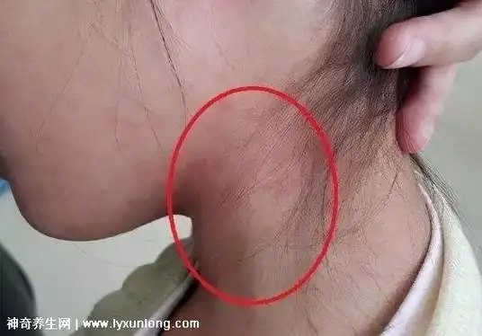 5cm,脖子上的淋巴结一般是摸不到的,但是万一,我们发现脖子那里凸起了