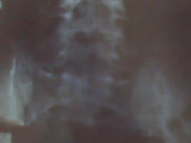 关于骶骨示隐性脊椎裂