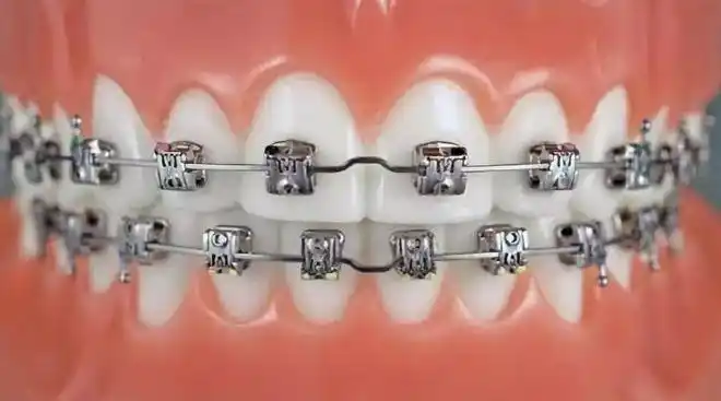 在廊坊,牙齿矫正器越贵效果越好吗?|正畸|口腔|钢丝|牙套_网易订阅