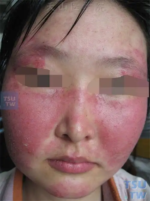系统性红斑狼疮-面部蝶形红斑:以鼻背为中心水肿性红斑,表面少许粘着