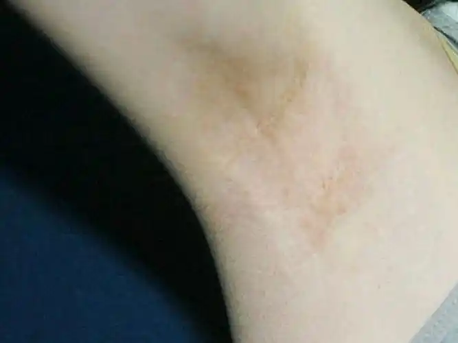 做完腋臭手术之后留下的疤痕,时间很长了,都出现色沉_圈子-新氧美容