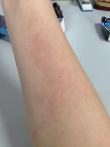 早上拖了地板,突然发现两条手臂长了大片红斑,不知道是什么回事,好痒