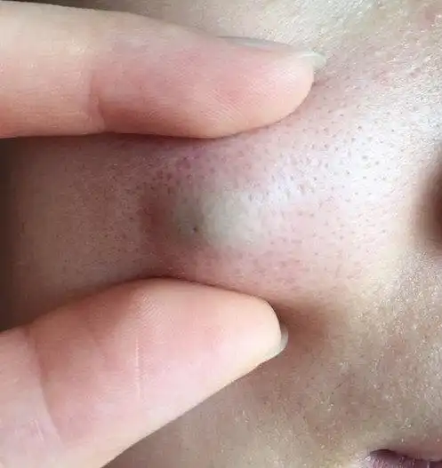 面部表皮囊肿_胆脂瘤_介绍_症状表现 - 好大夫在线