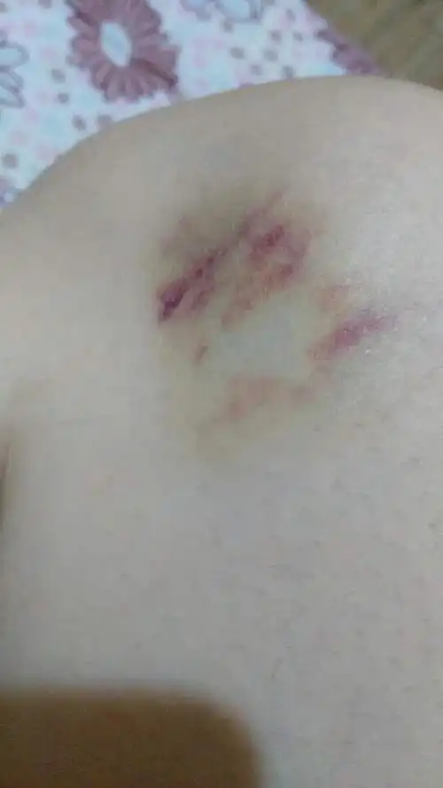 膝盖老是莫名其妙的淤青,前几天还是青的,现在好.