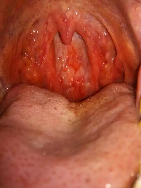 喉咙就有血,吐几口就没了,吃饭也正常,也不痛,去医院看说是慢性咽喉炎