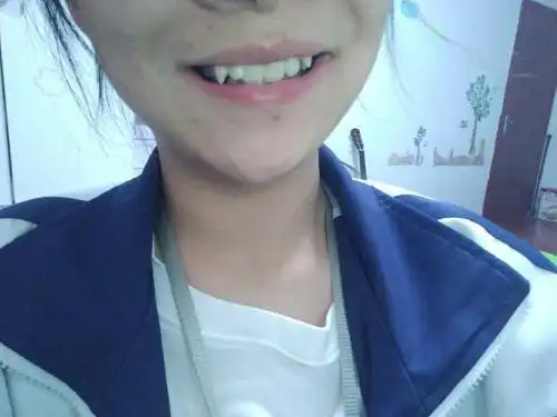 看图片,这样的虎牙怎么样影响美观吗?需要整吗