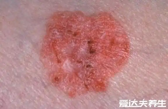 早期皮肤癌图片和症状,最严重的是黑色素瘤会致命