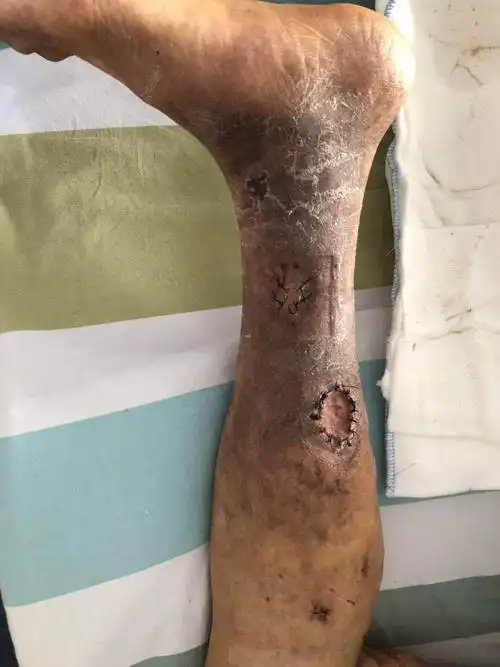 下肢静脉曲张_单纯性下肢静脉曲张_单纯性下肢静脉曲张症状表现 - 好