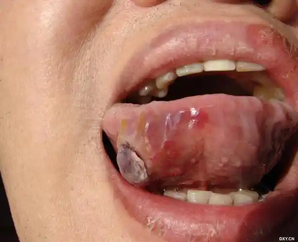 【求助】帮忙看一看这个舌部肿块