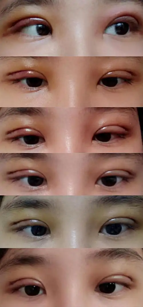 双眼皮一周记录我这是不是割太窄了