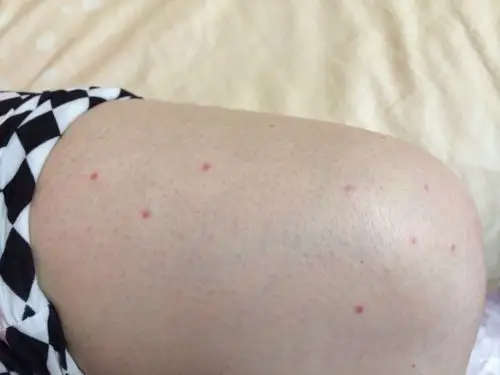 我老婆这几天身上出现很多小红点.不痛不痒.记忆中没吃什么别的东西.