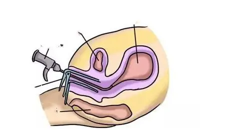 宫腔镜进行术前检查的原因有哪些呢