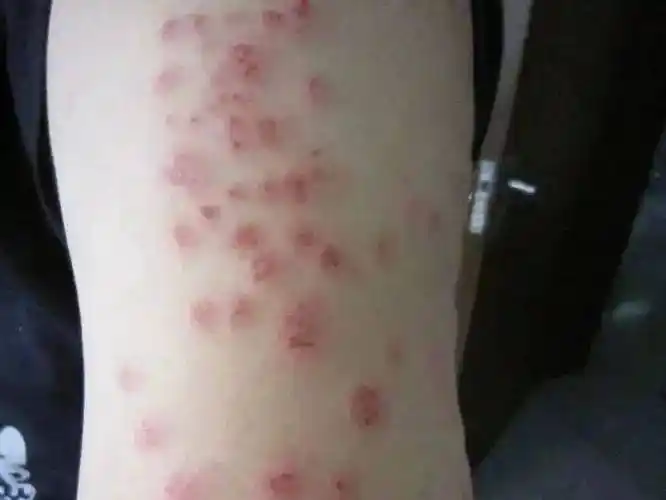 臭虫喜欢吸食人体和畜体的血液,人体被臭虫叮咬后,会出现皮肤红肿发炎