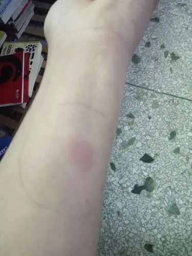 反复低烧午后低烧至37度5 6 三个月,做了ppd检查有没有问题