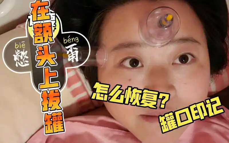 额头拔罐留下的这种印记会消失不?