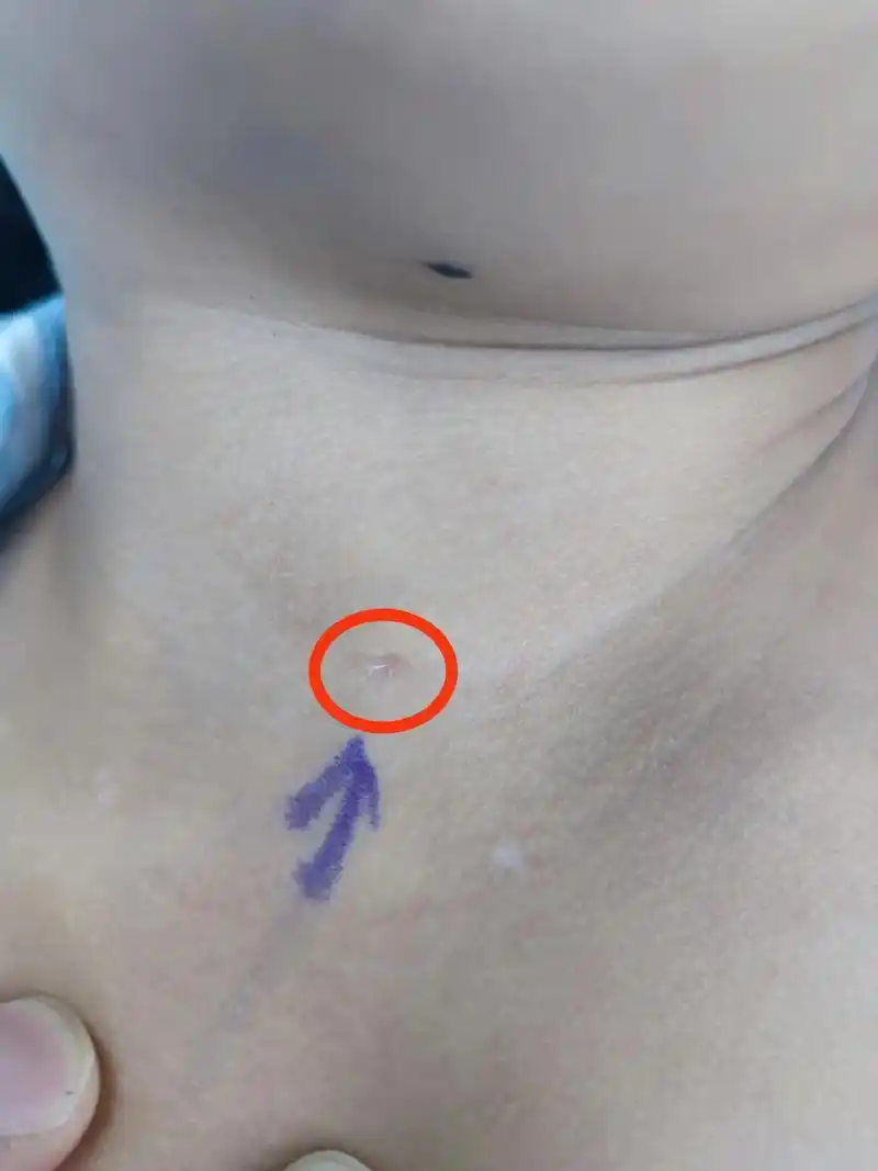鳃裂瘘管.儿童颈部有"小孔",挤压会有透明液体流出,这种情况 - 抖音
