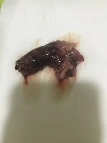 孕40天一直流血,60天排除了这个是不是孕囊?