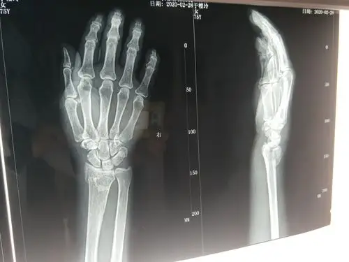 桡骨远端骨折手法复位前后对比 - 好大夫在线