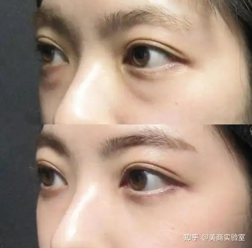 去眼袋内切,外切,眶隔释放哪种方式更佳?案例 价格全面对比