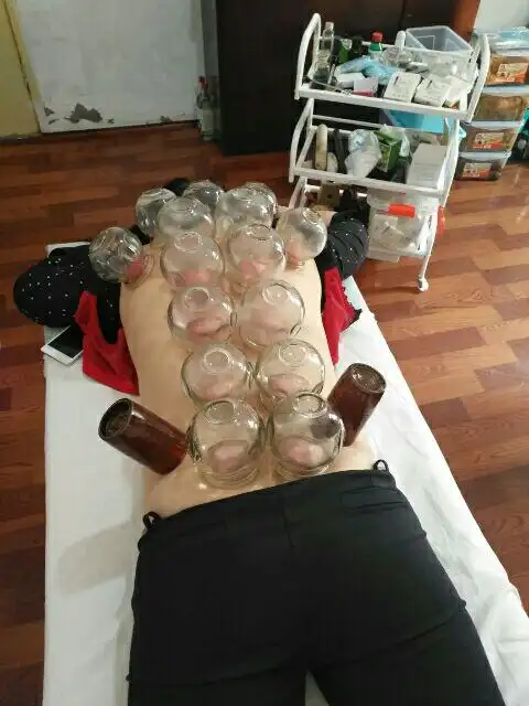 【拔上一罐,病去一半】 背部拔罐的好处90%的人都不知道,特别是我们