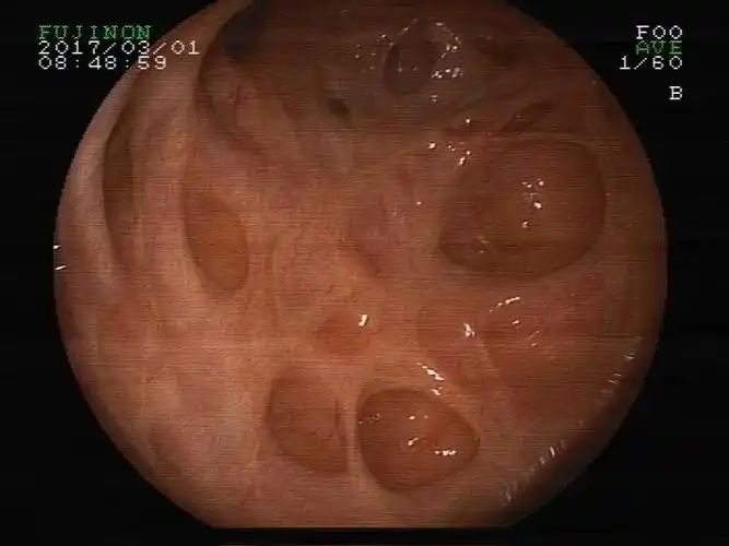 高纤维饮食,减少结肠憩室病的发生_肠疾病_疾病介绍_相关疾病 - 好
