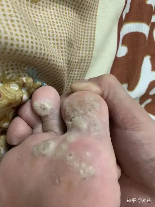 用激光治脚底的跖疣疼吗