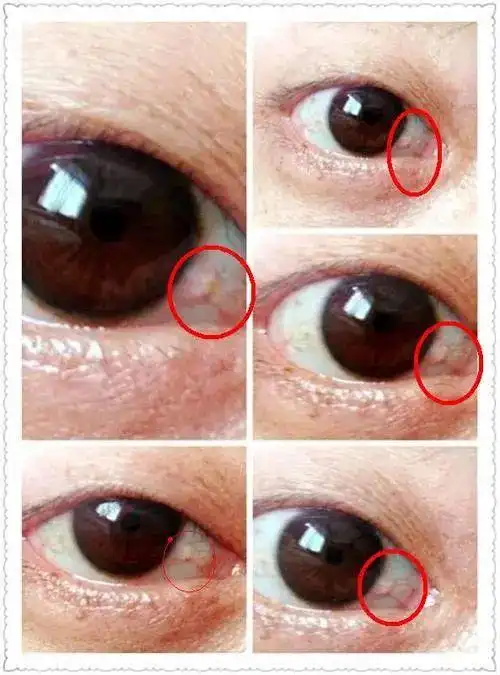 省中医名医教路眼睛长出黄色斑块对视力有影响吗