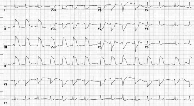 st 段抬高型心肌梗死(图 1),入院后又出现一次无脉性电活动(pea),心电