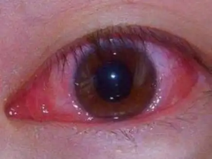 沙眼症状有哪些表现沙眼不同时期有不同症状