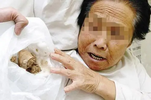 女性肾结石排出图片