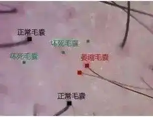 如果你在岳灵门店检测到头皮有空置的毛囊,毛囊中没有头发,这个毛囊就