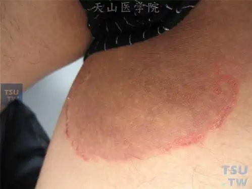 股癣(tinea cruris)的症状表现