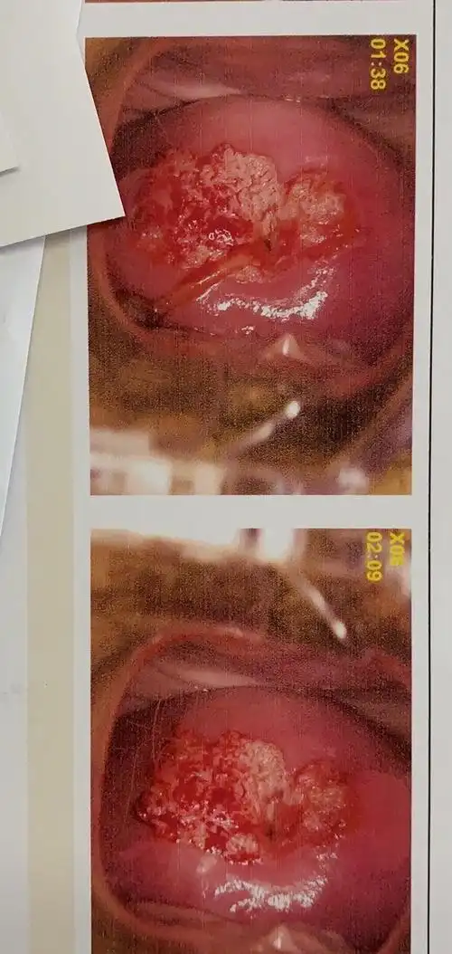 hpv6已阴道镜,活检cin1,有中重度糜烂