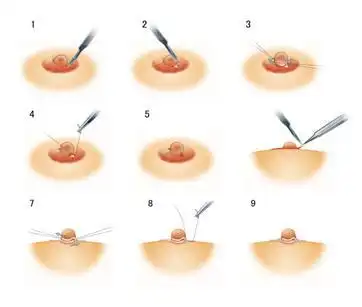 乳头内陷整形手术留疤痕吗?