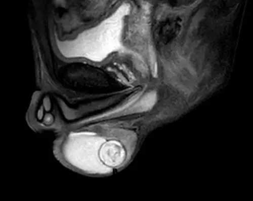 睾丸表皮样囊肿