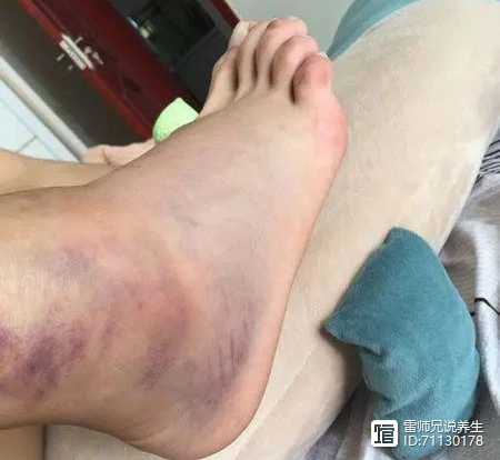 金黄散醋调外用心得走路崴脚红肿跌打损伤不用去医院