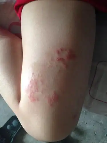 隔天身上起了红疹子医生说是手足.