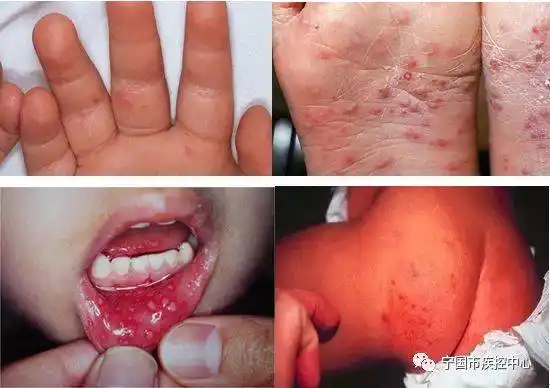 健康科普认识手足口病和疱疹性咽峡炎