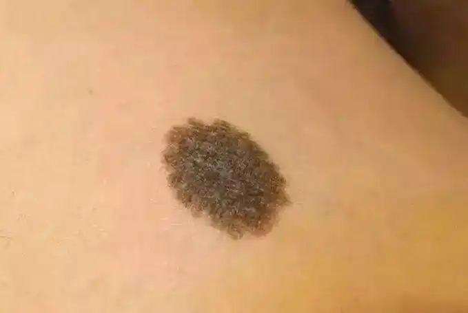 恶性黑色素瘤图片