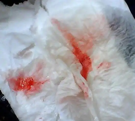 肺癌晚期都是"拖"出来的,3种咳嗽要重视,早做检查会更好