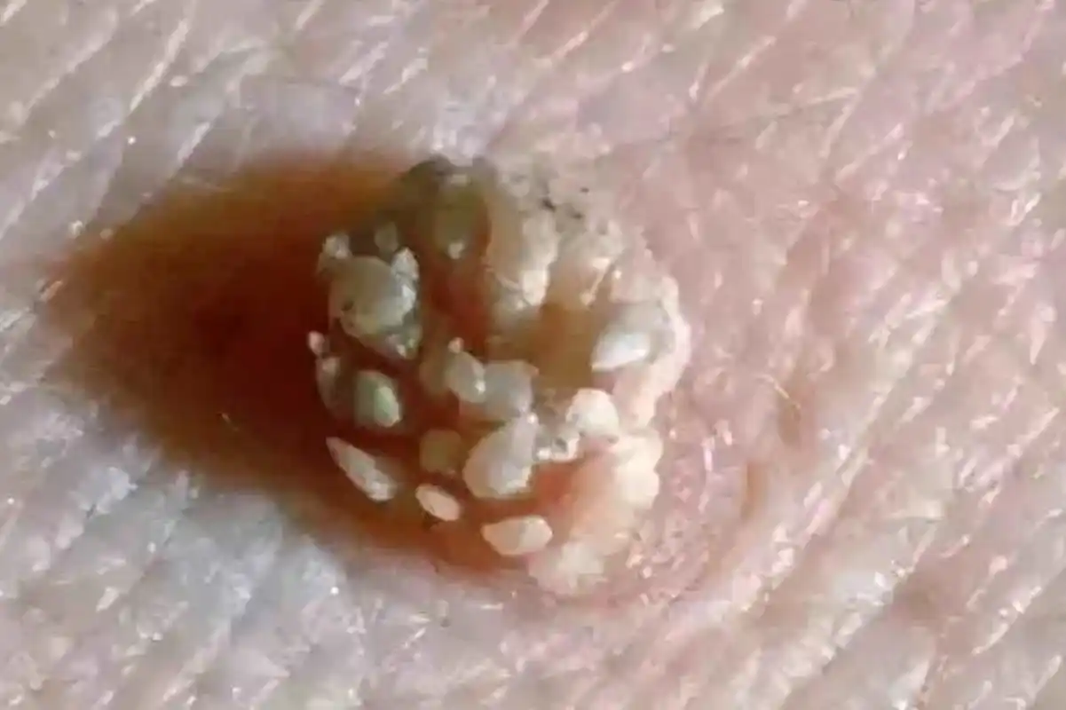 到屁股有一个肉疙瘩,越长越大,伴有疼痛出血,不得已,小陈到肛肠科就诊