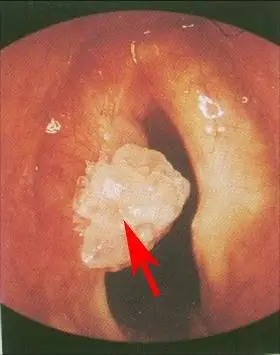 左声带喉乳头状瘤