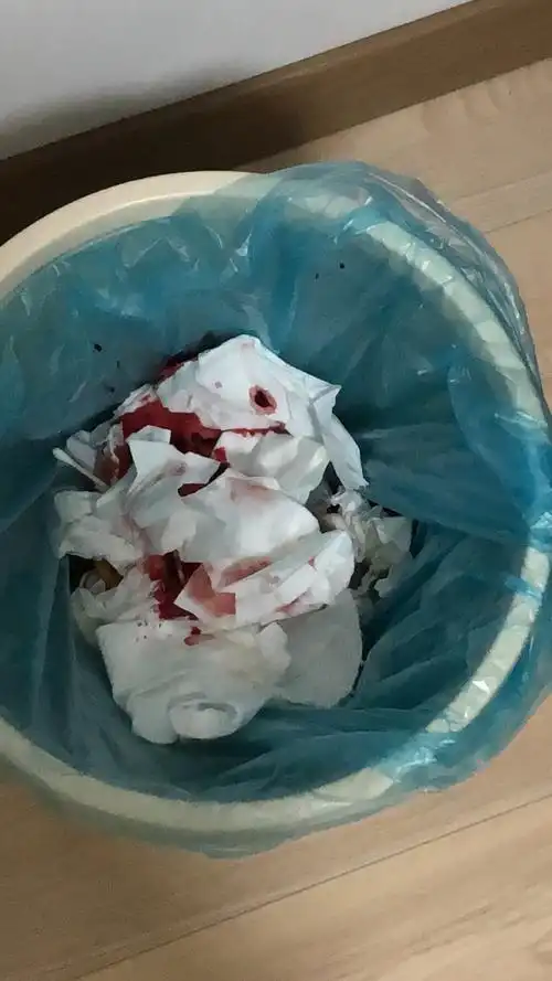 拔智齿流了很多血正常吗