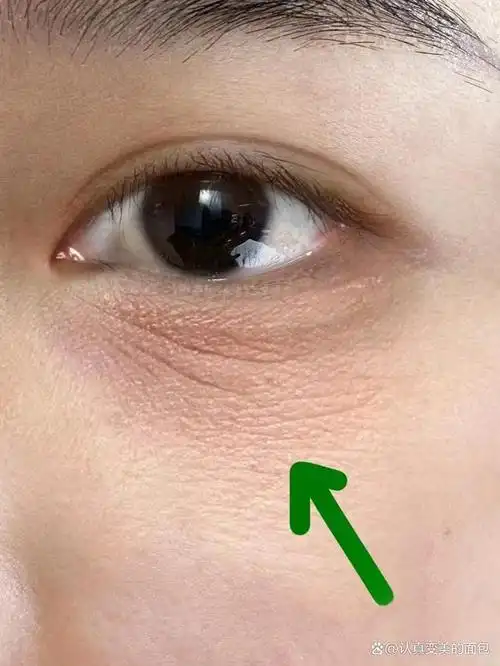 眼下皱纹如何缓解?