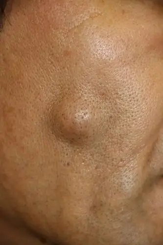 さあ,この粉瘤をどう治疗するか?