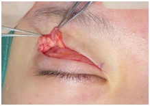 有一种"肿泡眼"叫做"泪腺脱垂"_泪腺脱垂 - 好大夫在线