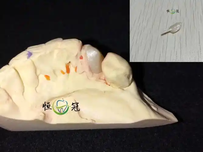 牙本质肩领的作用