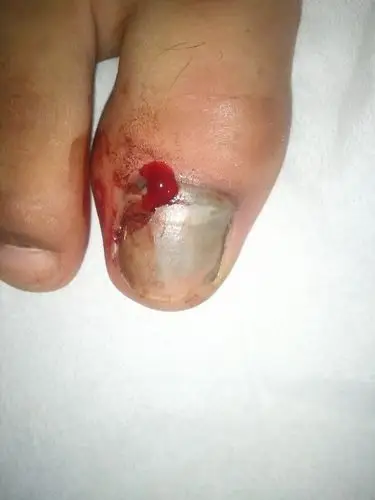 我的大母脚趾前天被板车压了一下 ,现在整个脚趾头都肿了,流血不止.